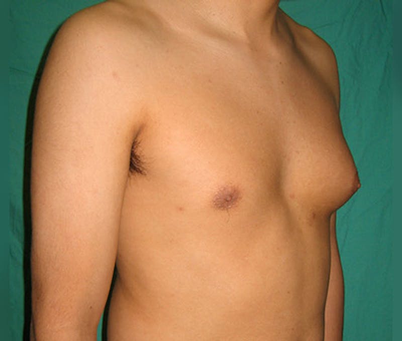 Gynecomastia Before & After Gallery - Patient 122908881 - Image 7