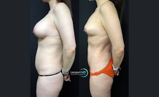 Breast Explant Before & After Gallery - Patient 122908878 - Image 3