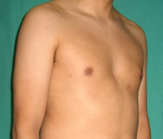 Gynecomastia Before & After Gallery - Patient 122908881 - Image 8