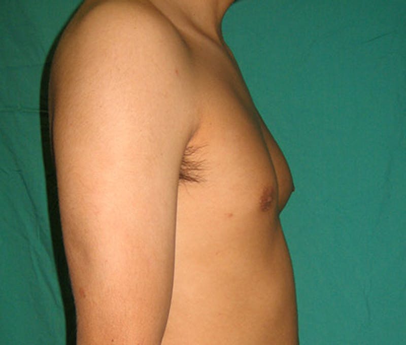Gynecomastia Before & After Gallery - Patient 122908881 - Image 9