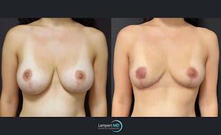 Breast Explant Before & After Gallery - Patient 122908884 - Image 1