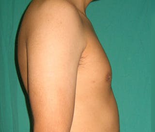 Gynecomastia Before & After Gallery - Patient 122908881 - Image 10