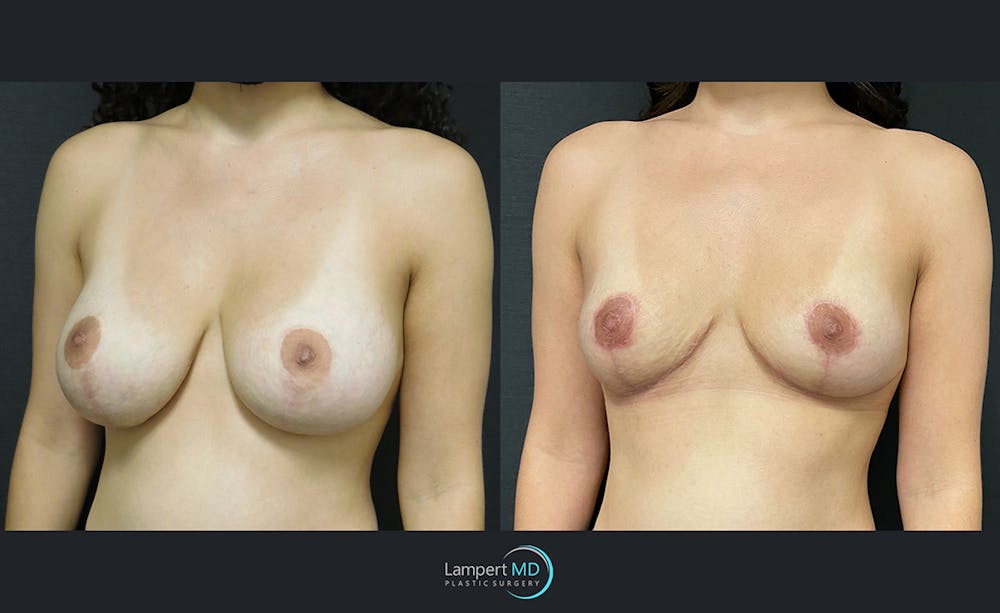 Breast Explant Before & After Gallery - Patient 122908884 - Image 2