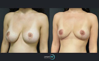 Breast Explant Before & After Gallery - Patient 122908884 - Image 2