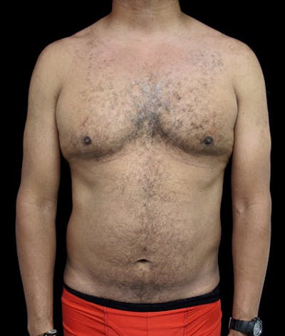 Gynecomastia Before & After Gallery - Patient 122908887 - Image 1