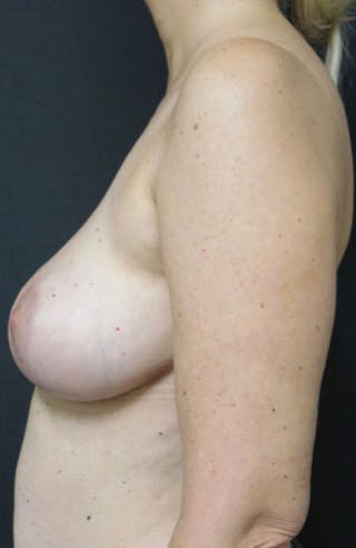 Breast Revision Before & After Gallery - Patient 122908894 - Image 22