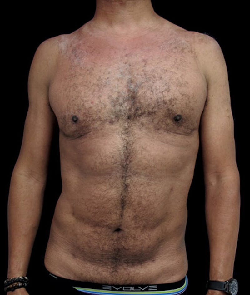 Gynecomastia Before & After Gallery - Patient 122908887 - Image 2