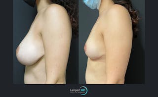 Breast Explant Before & After Gallery - Patient 122908884 - Image 3