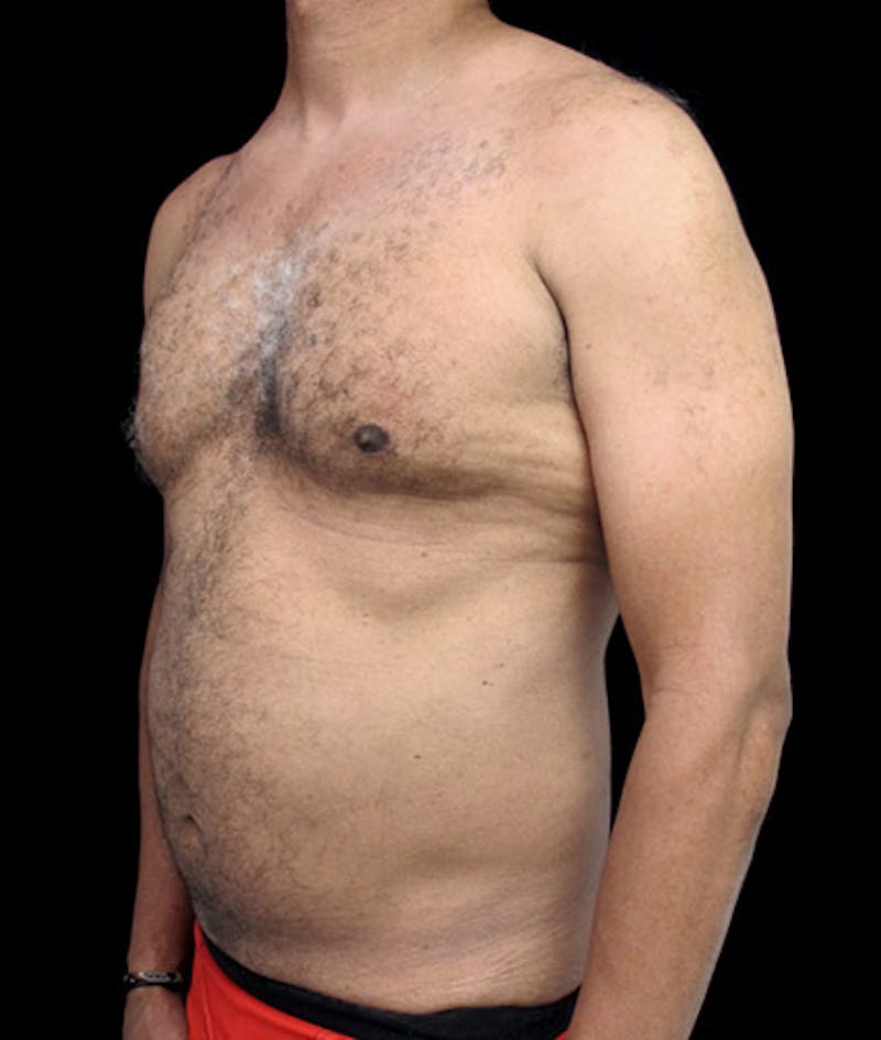 Gynecomastia Before & After Gallery - Patient 122908887 - Image 3