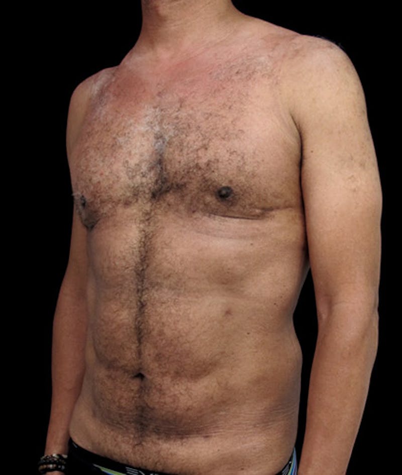 Gynecomastia Before & After Gallery - Patient 122908887 - Image 4