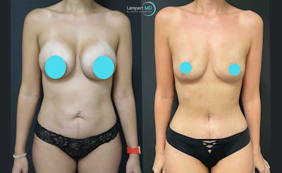 Breast Explant Before & After Gallery - Patient 122908889 - Image 1