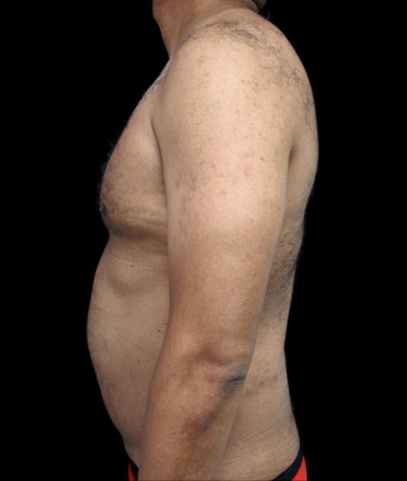 Gynecomastia Before & After Gallery - Patient 122908887 - Image 5