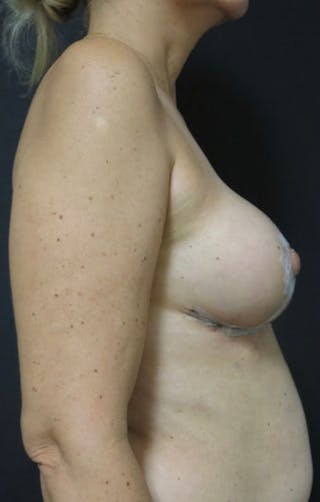 Breast Revision Before & After Gallery - Patient 122908894 - Image 26