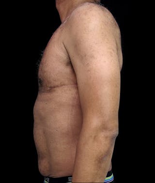Gynecomastia Before & After Gallery - Patient 122908887 - Image 6
