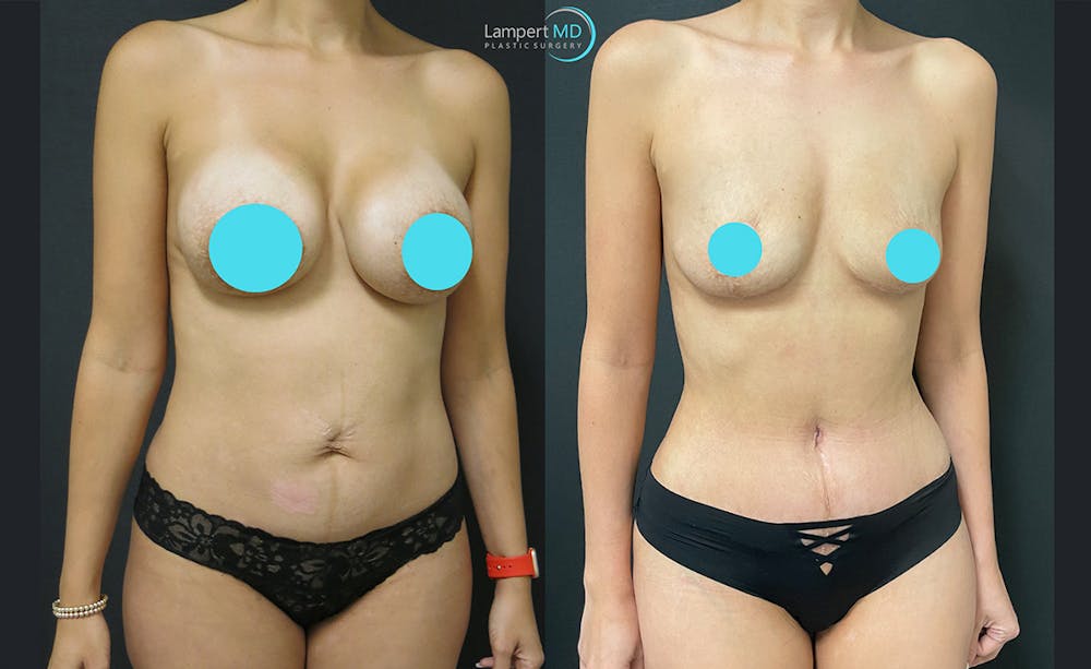 Breast Explant Before & After Gallery - Patient 122908889 - Image 2