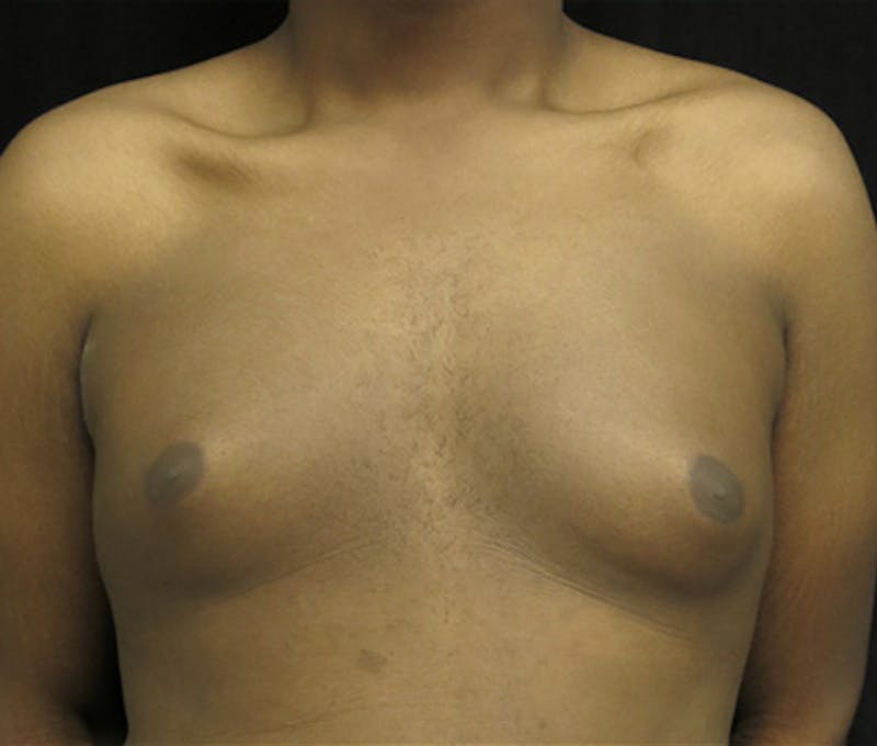 Gynecomastia Before & After Gallery - Patient 122908896 - Image 1