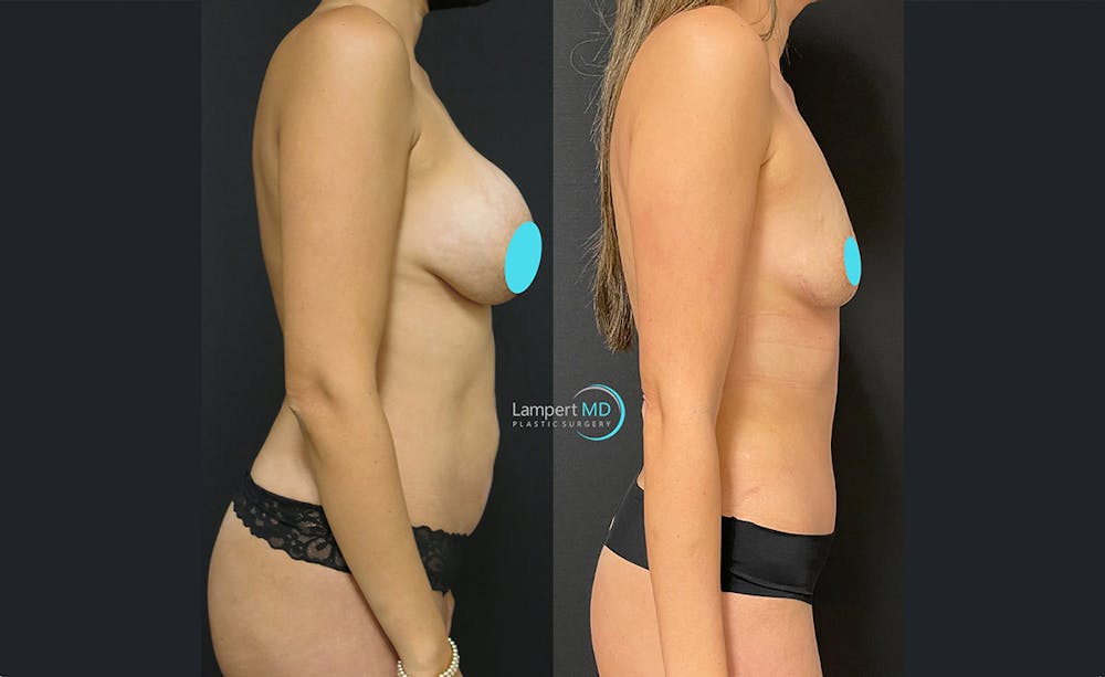 Breast Explant Before & After Gallery - Patient 122908889 - Image 3