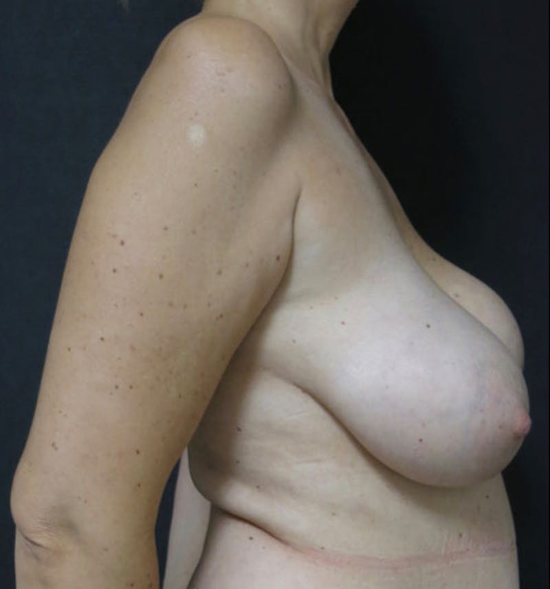 Breast Revision Before & After Gallery - Patient 122908894 - Image 29