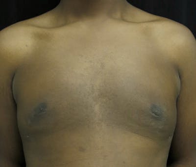 Gynecomastia Before & After Gallery - Patient 122908896 - Image 2