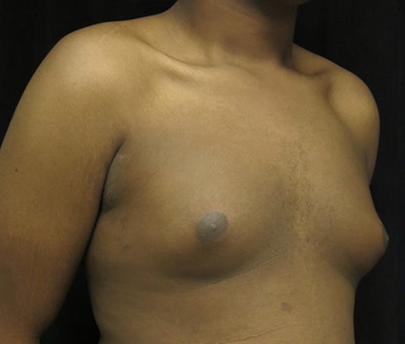 Gynecomastia Before & After Gallery - Patient 122908896 - Image 3