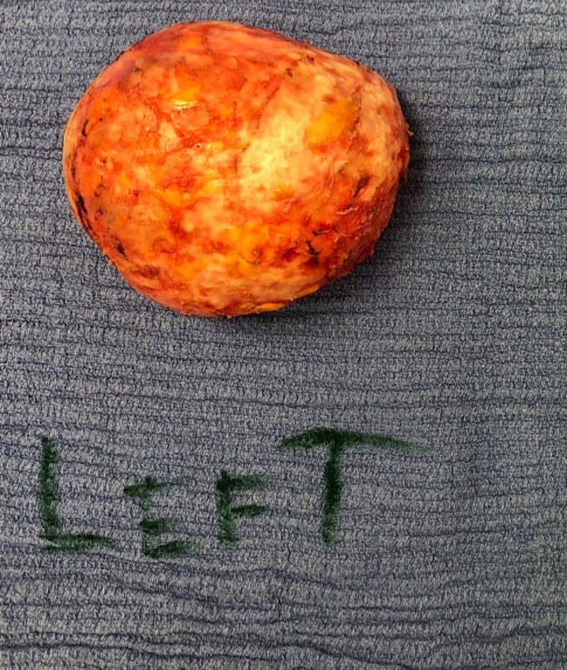 Breast Revision Before & After Gallery - Patient 122908894 - Image 31