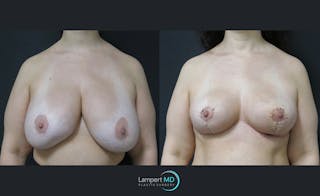 Breast Explant Before & After Gallery - Patient 122908891 - Image 1