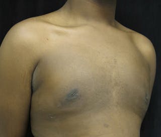 Gynecomastia Before & After Gallery - Patient 122908896 - Image 4