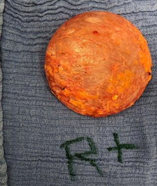 Breast Revision Before & After Gallery - Patient 122908894 - Image 32