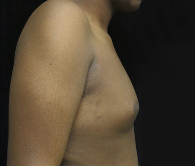 Gynecomastia Before & After Gallery - Patient 122908896 - Image 5