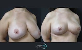 Breast Explant Before & After Gallery - Patient 122908891 - Image 2
