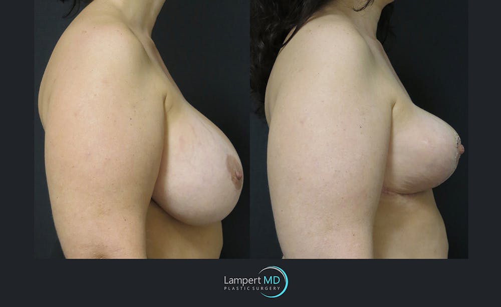 Breast Explant Before & After Gallery - Patient 122908891 - Image 3