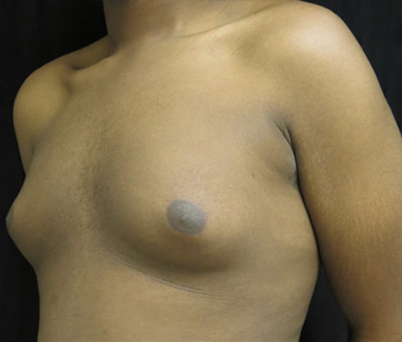 Gynecomastia Before & After Gallery - Patient 122908896 - Image 7