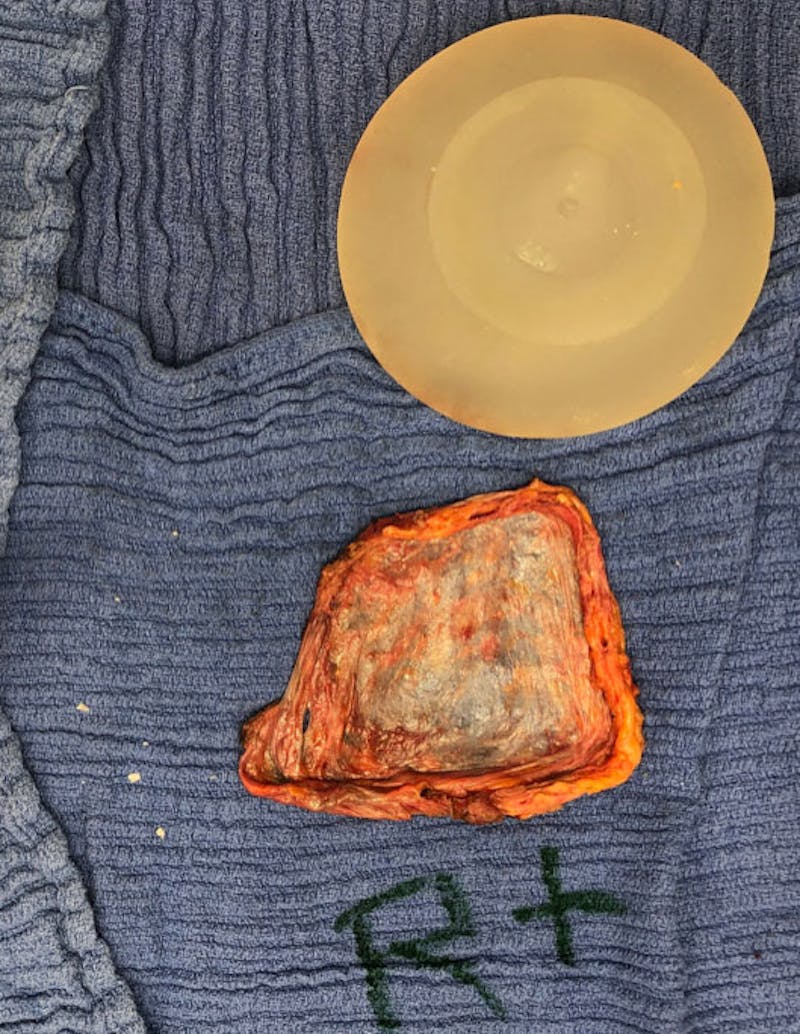 Breast Revision Before & After Gallery - Patient 122908894 - Image 34
