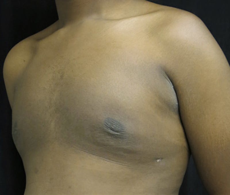 Gynecomastia Before & After Gallery - Patient 122908896 - Image 8