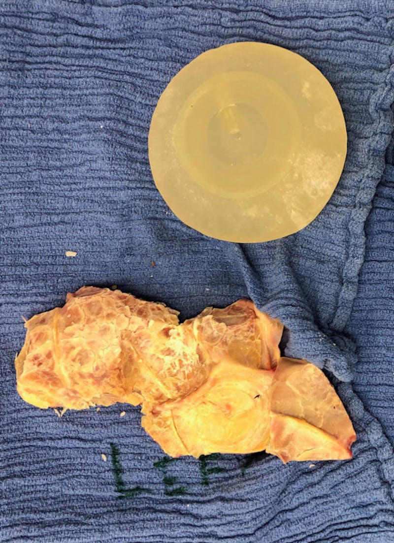 Breast Revision Before & After Gallery - Patient 122908894 - Image 35
