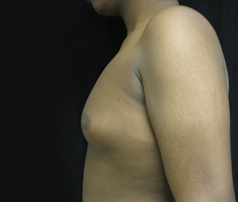 Gynecomastia Before & After Gallery - Patient 122908896 - Image 9