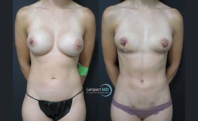 Breast Explant Before & After Gallery - Patient 122908898 - Image 1