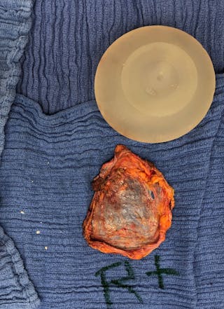 Breast Revision Before & After Gallery - Patient 122908894 - Image 36