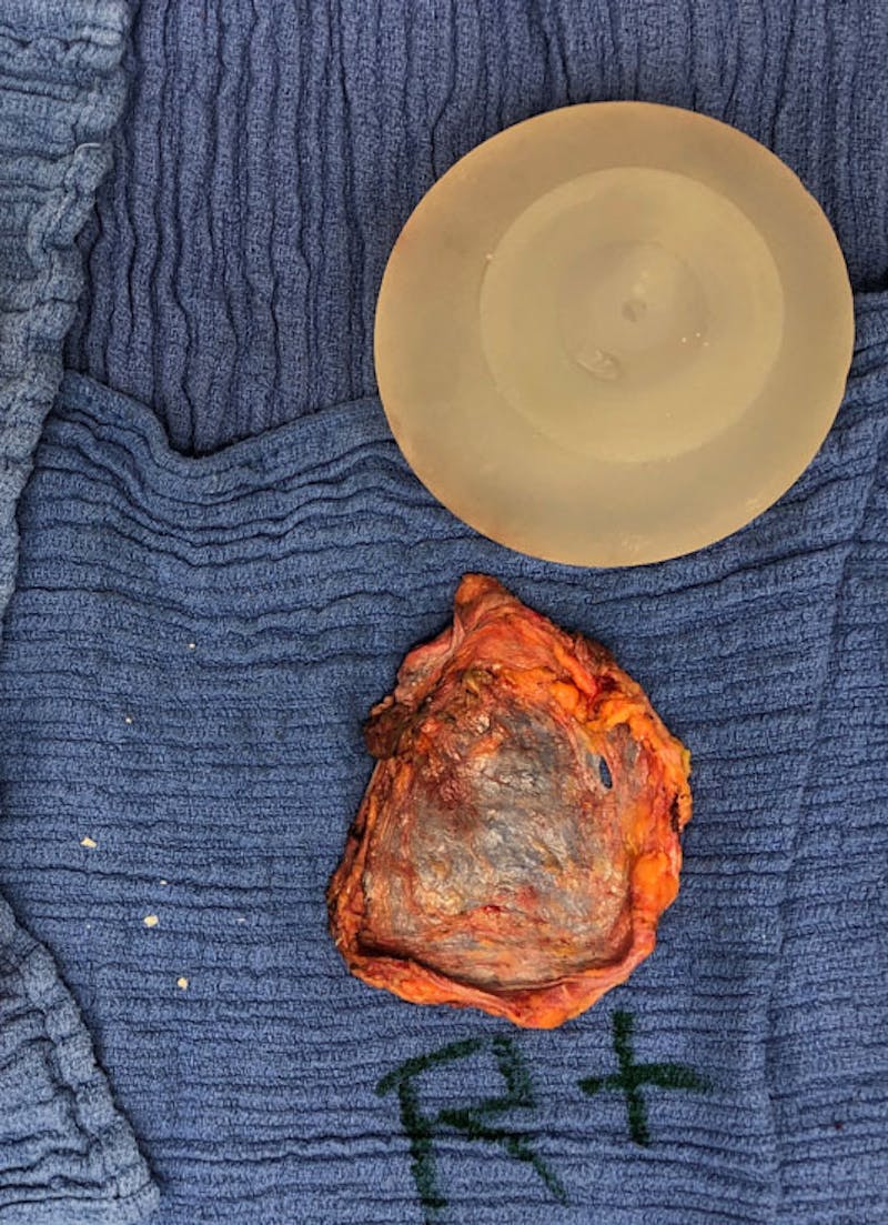 Breast Revision Before & After Gallery - Patient 122908894 - Image 36