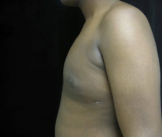 Gynecomastia Before & After Gallery - Patient 122908896 - Image 10