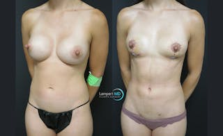 Breast Explant Before & After Gallery - Patient 122908898 - Image 2