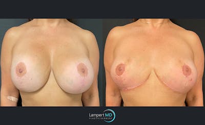 Breast Explant Before & After Gallery - Patient 122908899 - Image 1