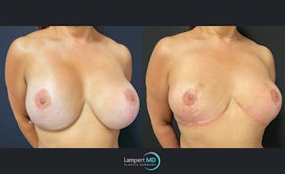 Breast Explant Before & After Gallery - Patient 122908899 - Image 2