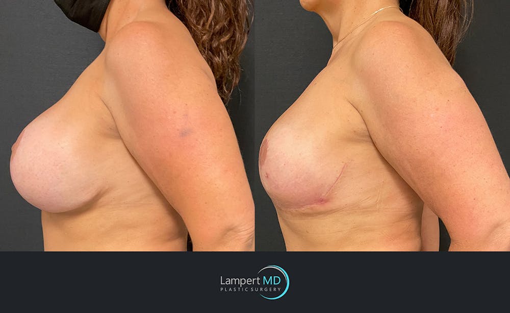 Breast Explant Before & After Gallery - Patient 122908899 - Image 3