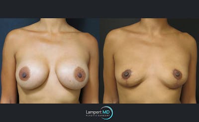 Breast Explant Before & After Gallery - Patient 122908904 - Image 1