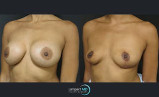 Breast Explant Before & After Gallery - Patient 122908904 - Image 2