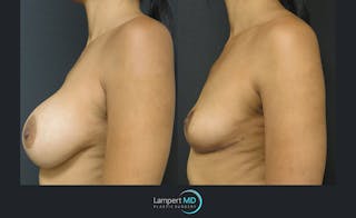 Breast Explant Before & After Gallery - Patient 122908904 - Image 3