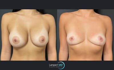 Breast Explant Before & After Gallery - Patient 122908906 - Image 1