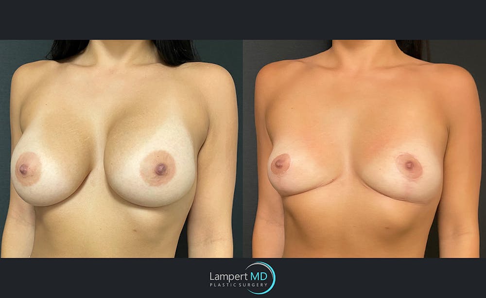 Breast Explant Before & After Gallery - Patient 122908906 - Image 2