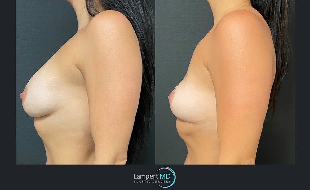 Breast Explant Before & After Gallery - Patient 122908906 - Image 3